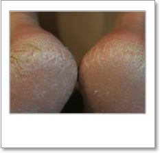 Heels of feet showing signs of autonomic neuropathy