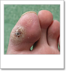 Callus on large toe