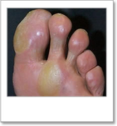Calluses on large toe and ball of second toe