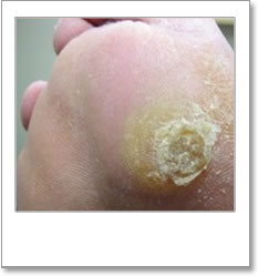 Callus on ball of foot