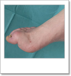 Foot with Pes cavus