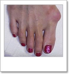 Structural abnormality between large toe and instep