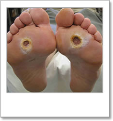 Ulceration on the balls of both feet