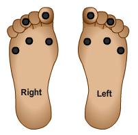 Jennifer's feet with monofilament sites